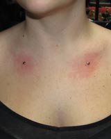 img_implant_dermal_anchor_collarbone_second