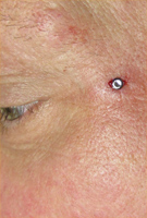 Dermal Anchor Eye